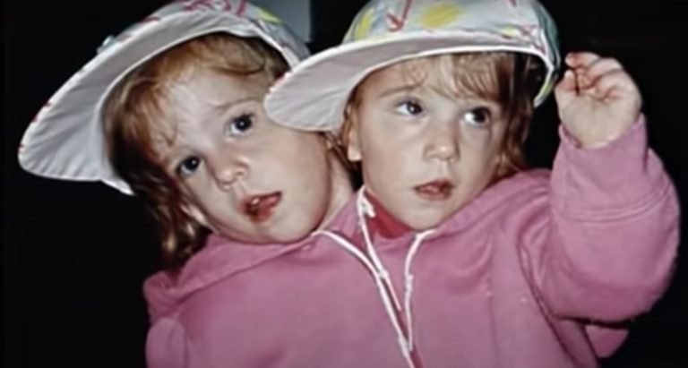 Mom of conjoined twins answers question everyone is asking