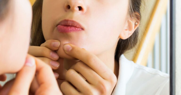 Doctors warn of popping pimple in ‘triangle of death’
